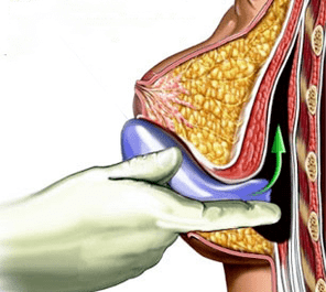 göğüs büyütme için implantasyon