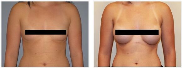ameliyat öncesi ve sonrası göğüsler
